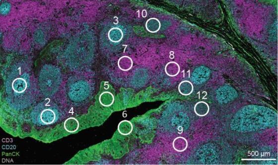 重磅 : PD-L1蛋白表达数字化测定在非小细胞肺癌组织微阵列中的诊断应
